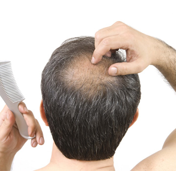 Hair Transplant