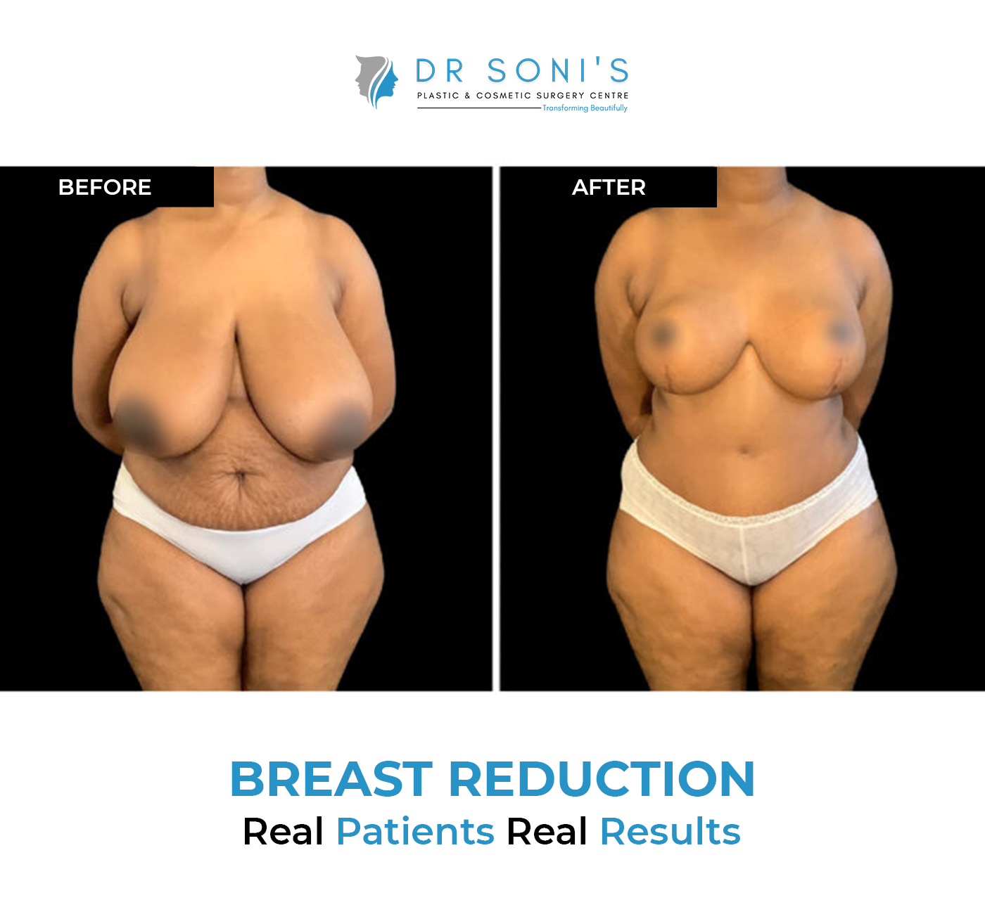 What Is breast Reduction?