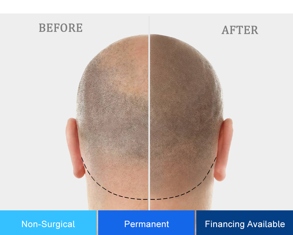 scalp micropigmentation