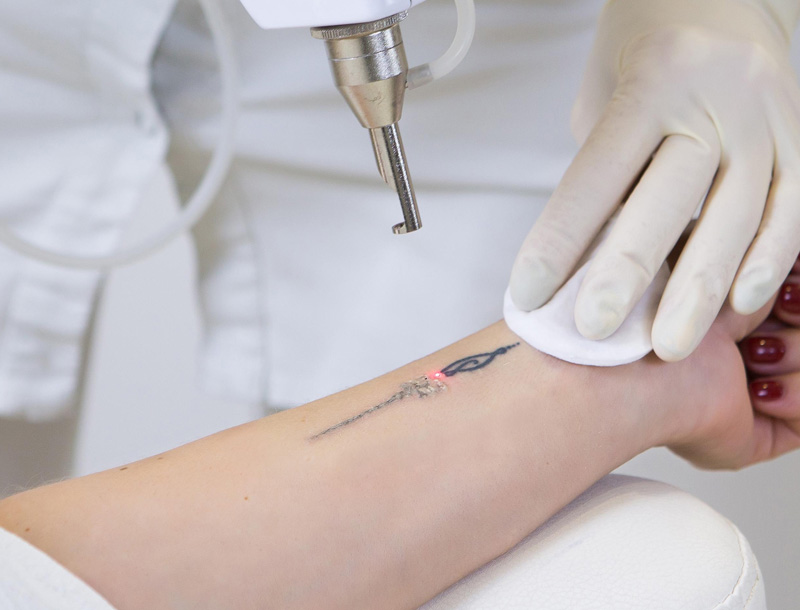 tattoo removal procedure